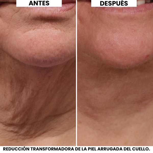 Crema Lifting de Cuello Evonex®
