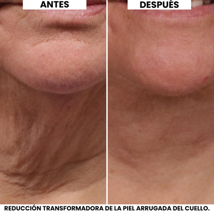 Crema Lifting de Cuello Evonex®
