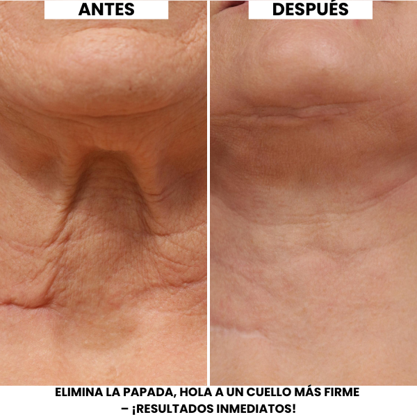 Crema Lifting de Cuello Evonex®